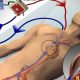 ECMO: o que é, como funciona e em que caso é utilizado?