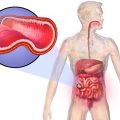 Doença de Crohn: o que é, causas, sintomas, diagnóstico e tratamento