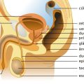 Fimose: o que é, sintomas, tipos e tratamento